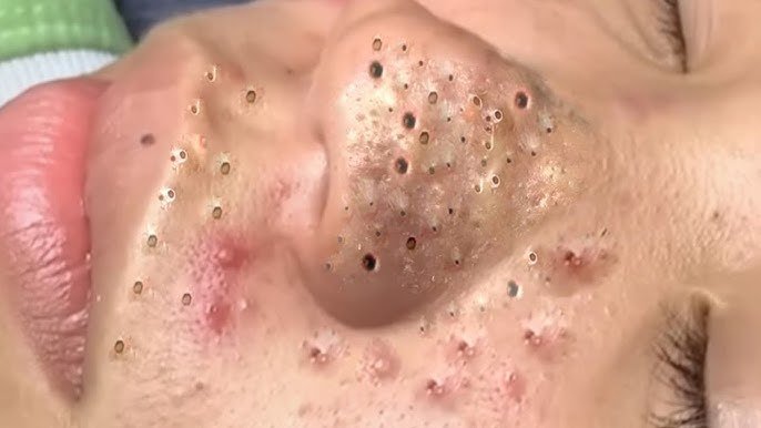 Blackhead Removal 5
